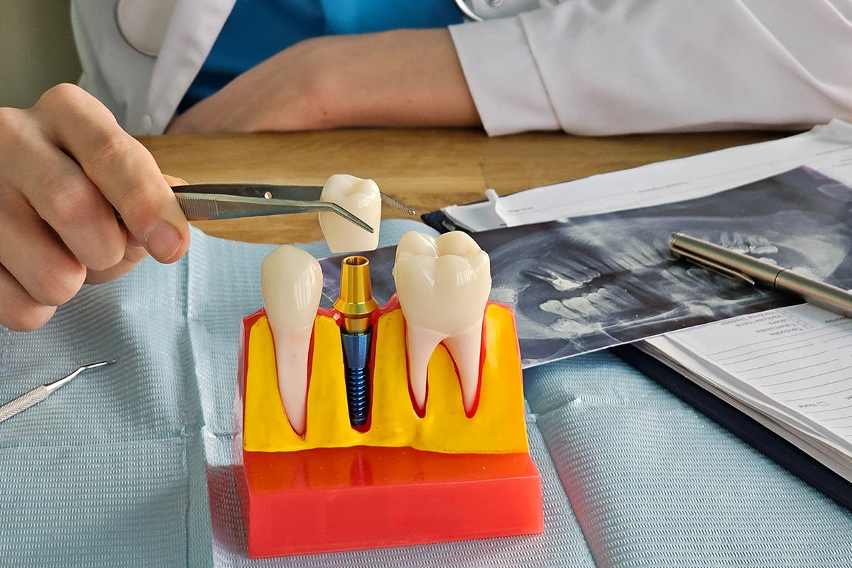 5 Common Mistakes to Avoid After Getting Dental Implants
