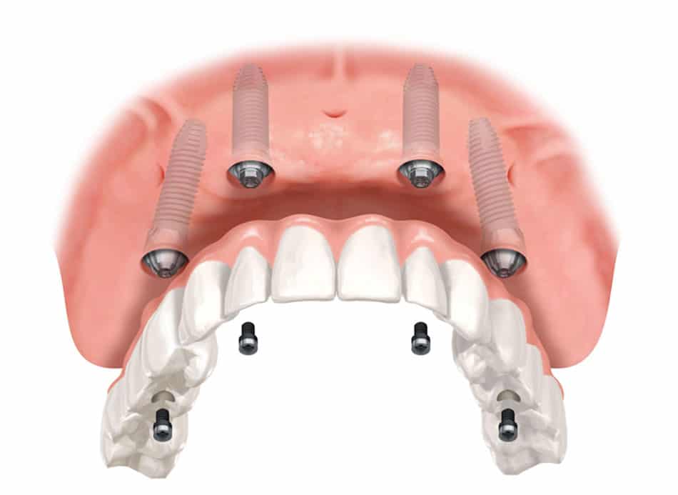 Full Arch with Only 4 Implants