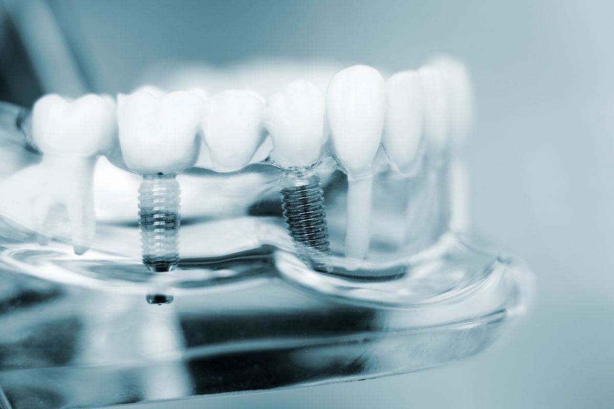 Am I a Candidate for Dental Implants?