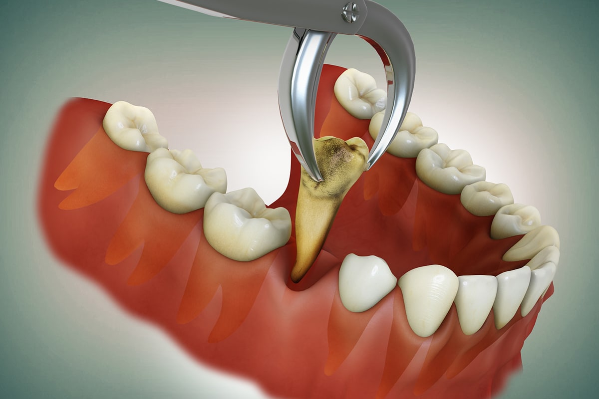 Can I Drive After Getting a Tooth Extraction?