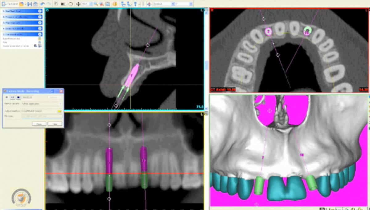 Dental Implant Imaging