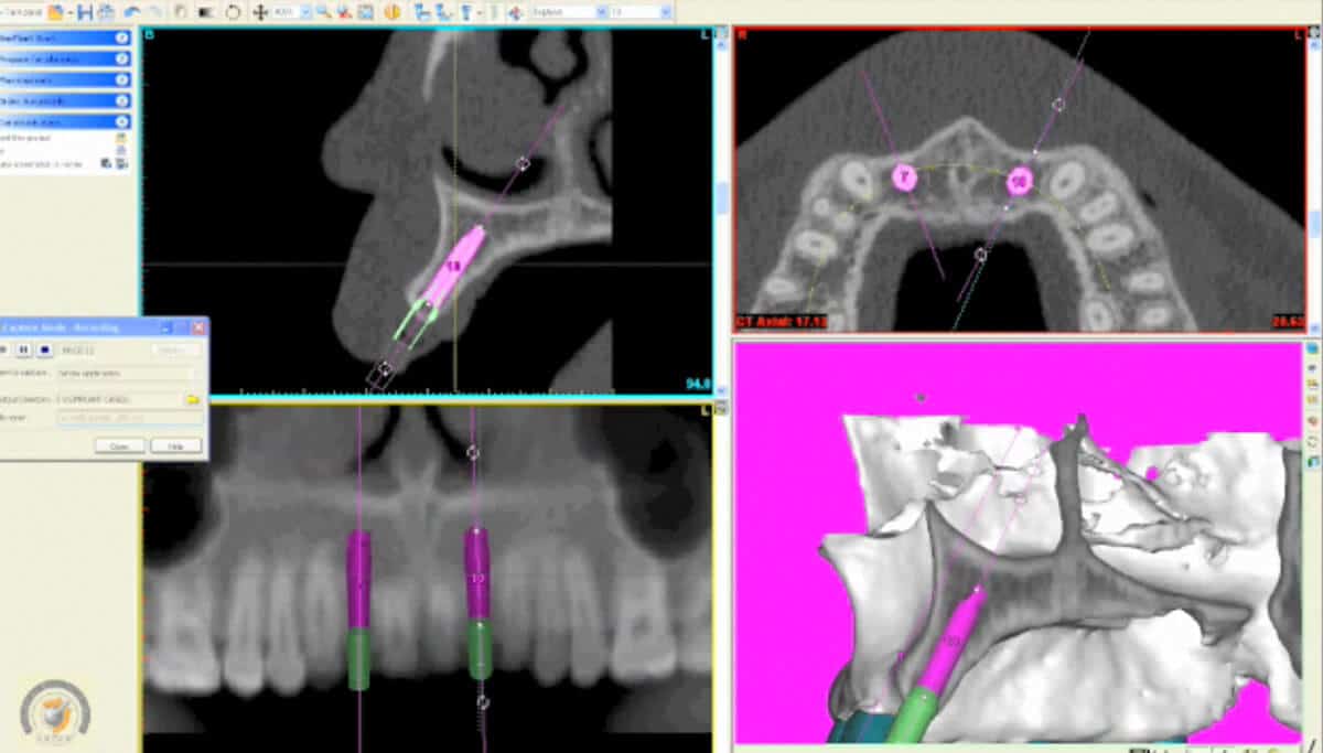 Dental Implant Imaging