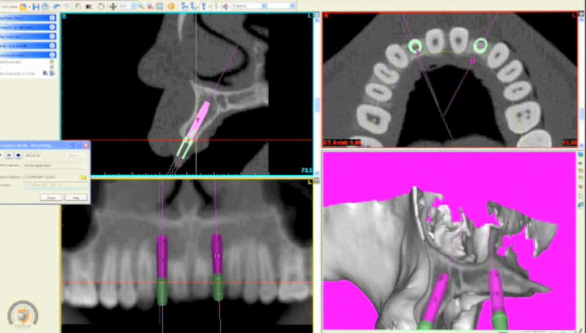 Dental Implant Imaging