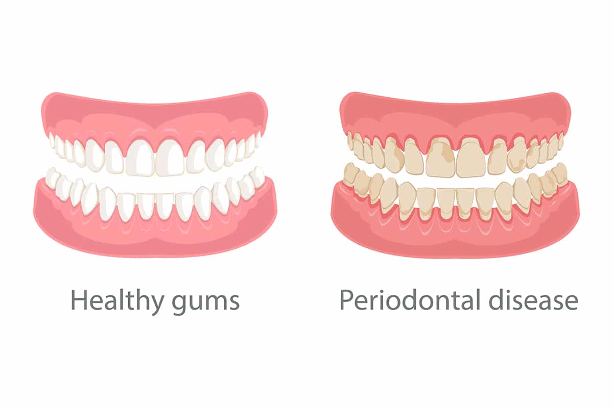 How Do You Fix Gum Recession?