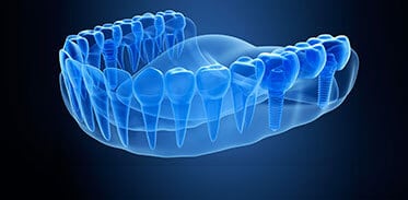 3D Dental Implant Imaging