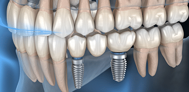 Dental Implants