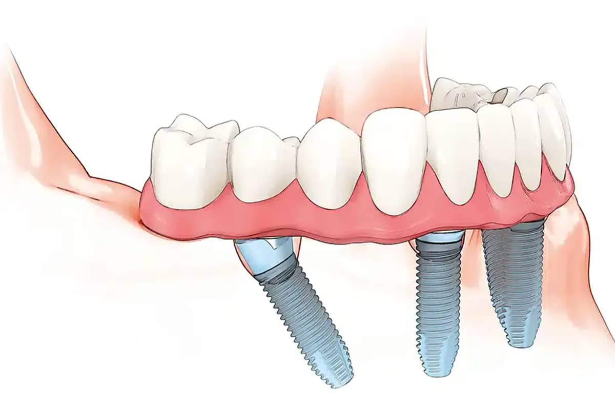 What Makes All-On-4 Implants a Good Solution for Bone Loss?