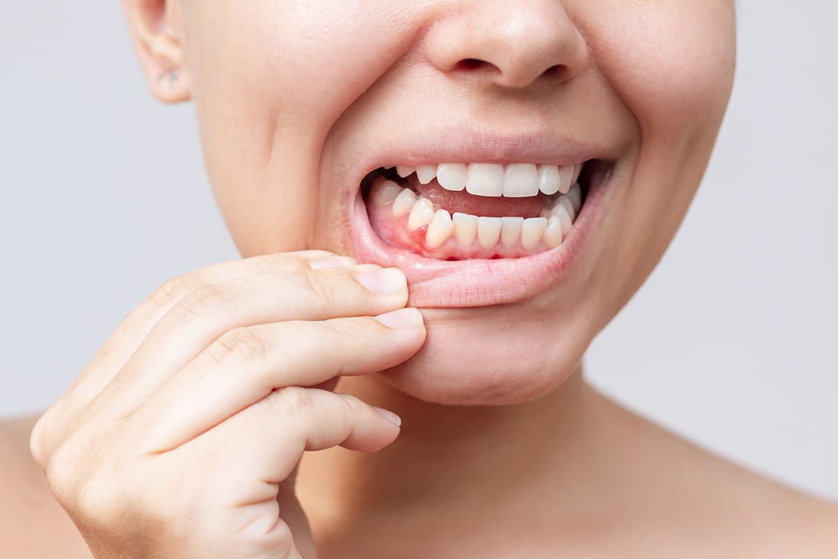 Why Bleeding Gums Shouldn’t Be Ignored: A Periodontist’s Perspective